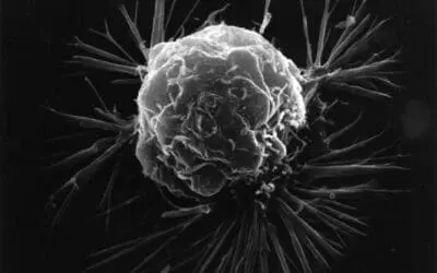 HSF2 mechanism discovered in breast cancer progression