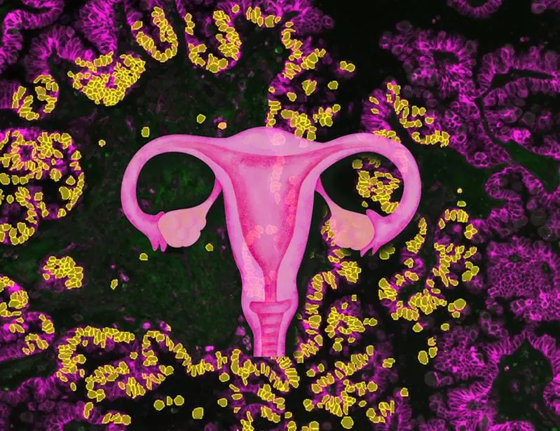 Potential breakthrough in the treatment of ovarian cancer