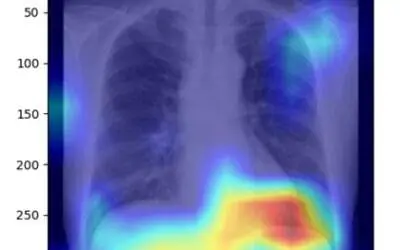 AI model recognizes fatty liver based on X-ray images