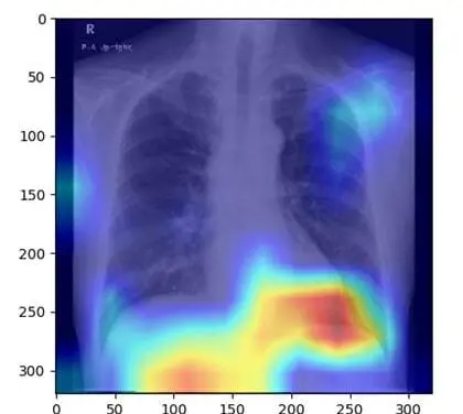 AI model recognizes fatty liver based on X-ray images