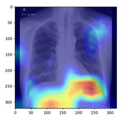 AI model recognizes fatty liver based on X-ray images