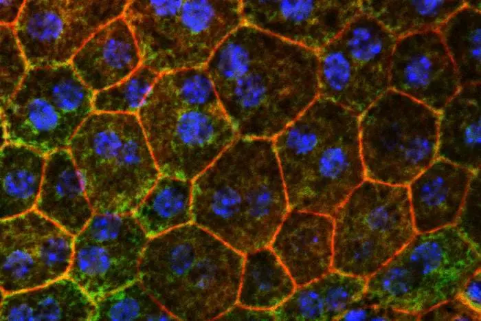 Cholesterol metabolism offers new approach against macular degeneration