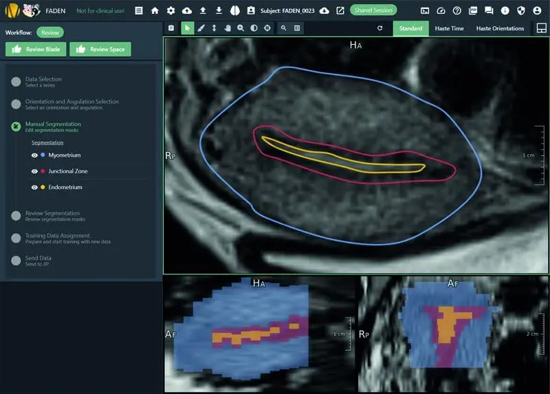 Diagnostics: RACOON THREAD revolutionizes early detection of adenomyosis