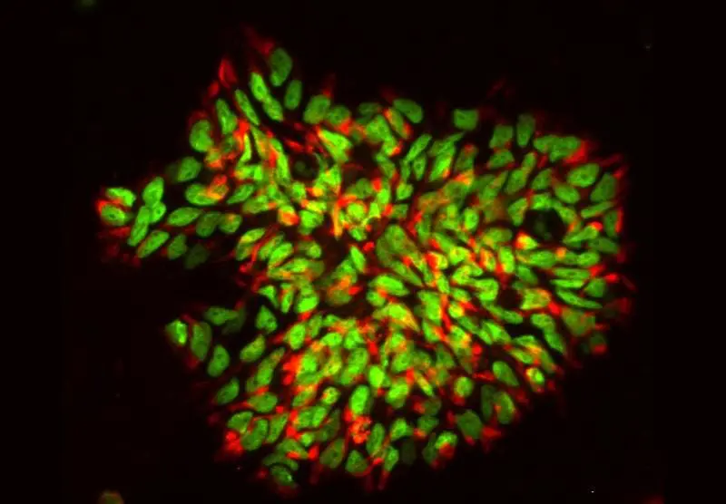 Multiple sclerosis: stem cells repair nerve damage