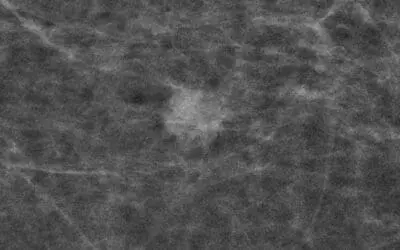 Study proves: Mammography screening significantly reduces breast cancer mortality