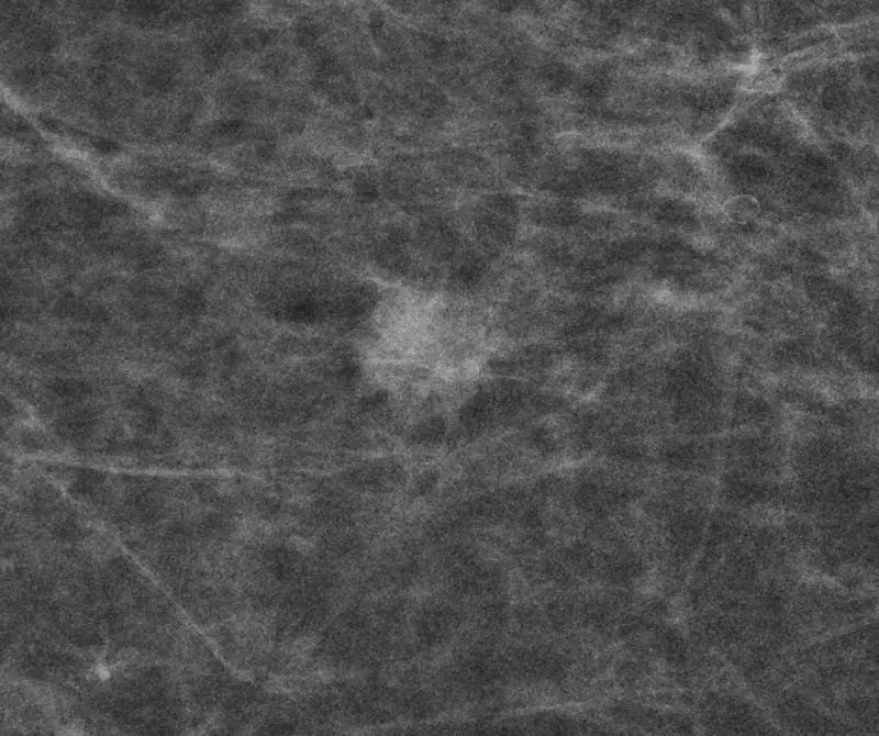 Study proves: Mammography screening significantly reduces breast cancer mortality