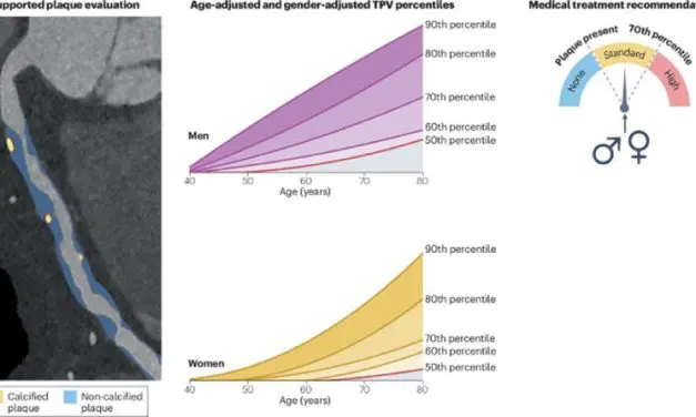 New recommendations for individualized treatment of hardening of the arteries through AI-assisted CT analysis