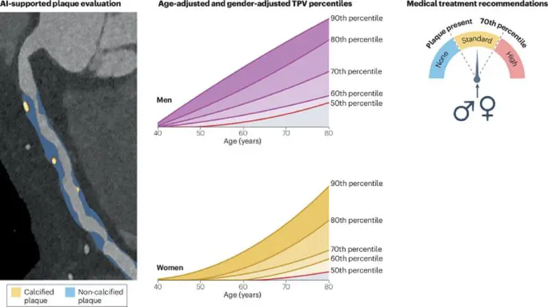 New recommendations for individualized treatment of hardening of the arteries through AI-assisted CT analysis