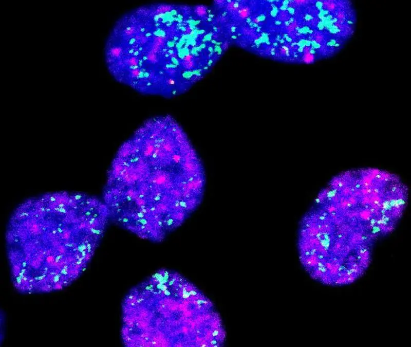 New therapeutic approach against aggressive neuroblastomas discovered