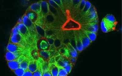 New hope for people with rectal cancer