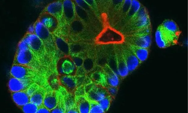 New hope for people with rectal cancer