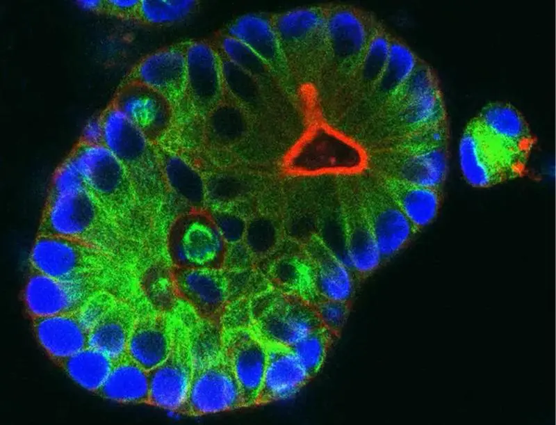 New hope for people with rectal cancer