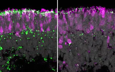 Human organoids: Gene therapy against blindness in childhood dementia successfully tested