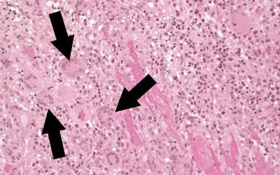 Fulminant myocarditis: Study provides approaches for better diagnostics and therapy