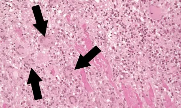 Fulminant myocarditis: Study provides approaches for better diagnostics and therapy