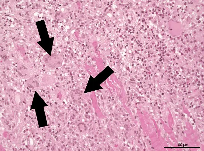 Fulminant myocarditis: Study provides approaches for better diagnostics and therapy