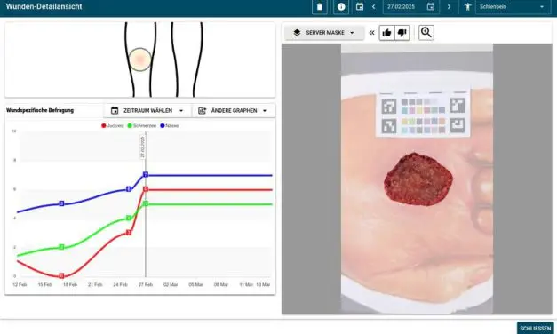 Würzburg research team develops AI app for monitoring chronic wounds