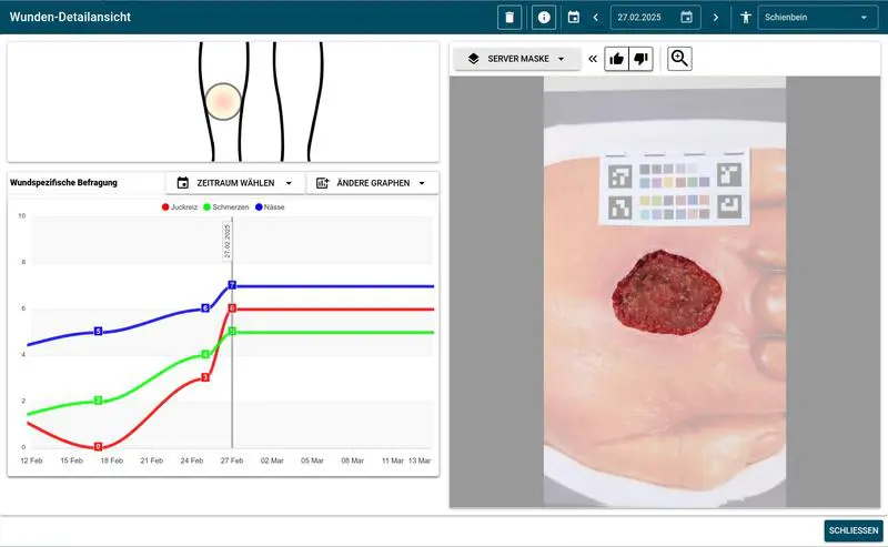 Würzburg research team develops AI app for monitoring chronic wounds