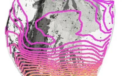 New imaging reveals causes of sudden cardiac death