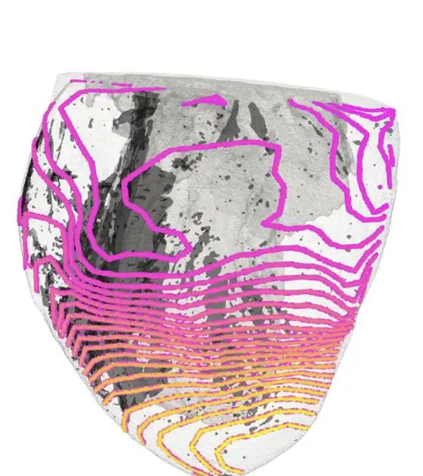 New imaging reveals causes of sudden cardiac death