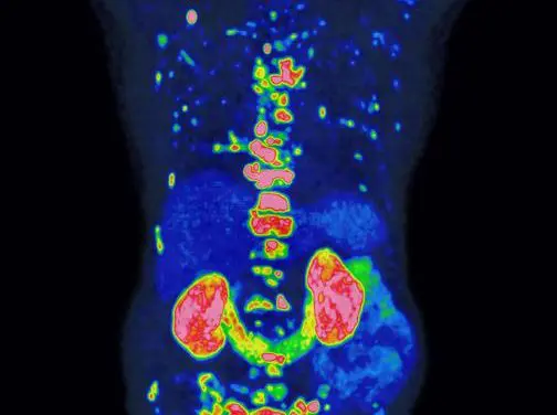 Award for groundbreaking method for the prognosis and treatment of prostate cancer