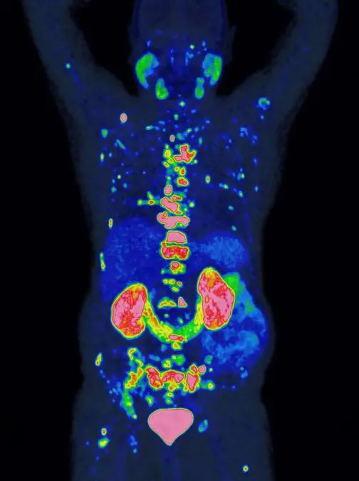 Award for groundbreaking method for the prognosis and treatment of prostate cancer