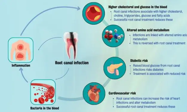 Root canal treatments reduce the risk of heart disease and diabetes