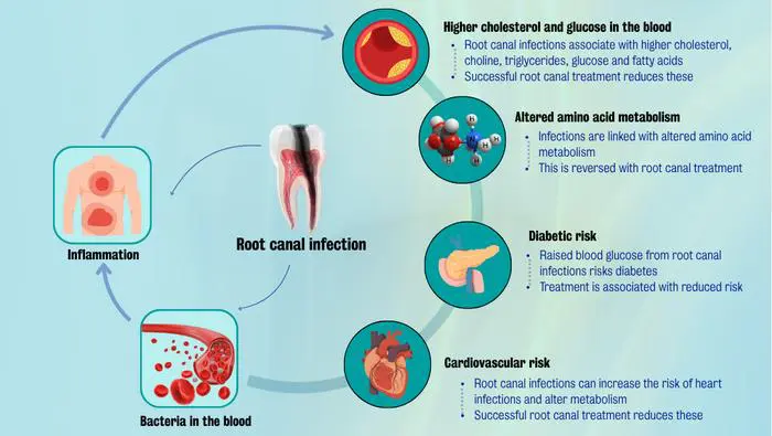 Root canal treatments reduce the risk of heart disease and diabetes