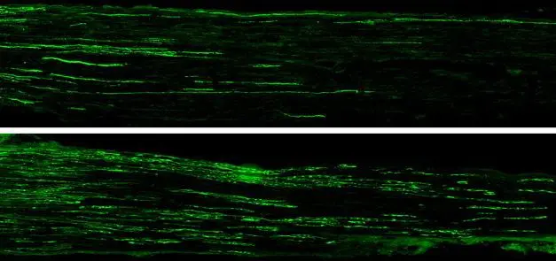Nerve regeneration in diabetes: New peptide could revolutionize therapy