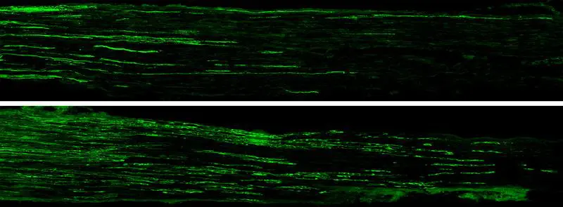 Nerve regeneration in diabetes: New peptide could revolutionize therapy