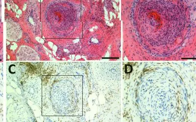European consortium investigates causes of neuropathic pain