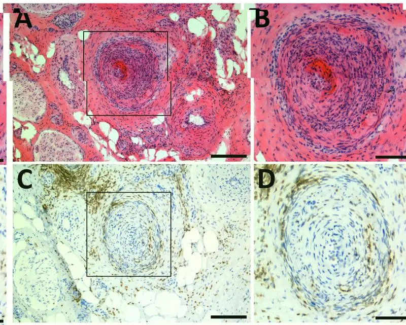 European consortium investigates causes of neuropathic pain