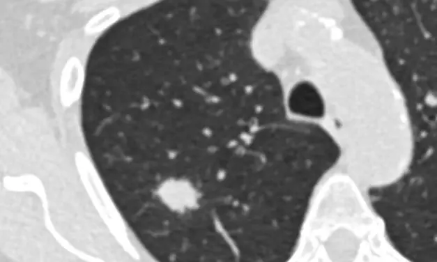 Study calls for expanded criteria for early detection of lung cancer