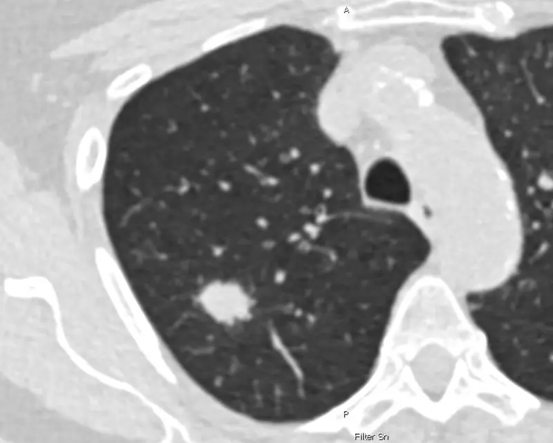 Study calls for expanded criteria for early detection of lung cancer