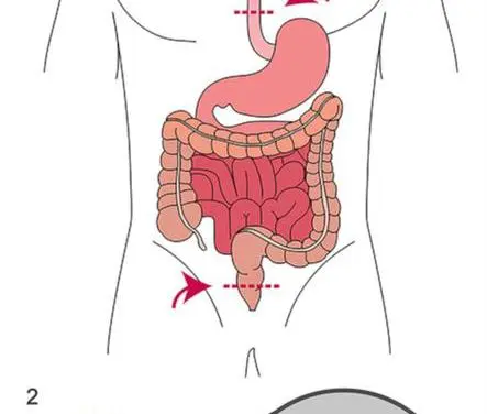 New sensor film revolutionizes early detection in bowel surgery