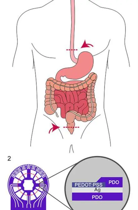 New sensor film revolutionizes early detection in bowel surgery