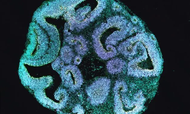 Brain organoids clarify the causes of rare developmental disorders