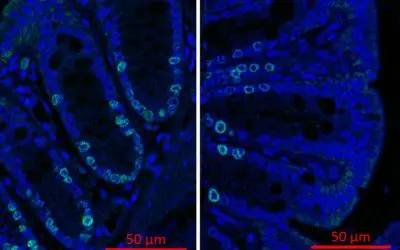 Secondary bile acids from intestinal bacteria promote colon cancer