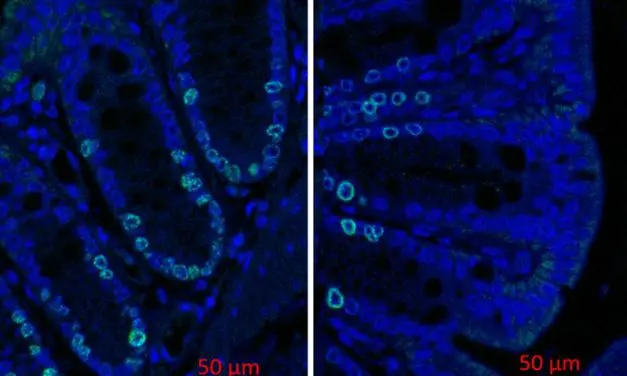 Secondary bile acids from intestinal bacteria promote colon cancer
