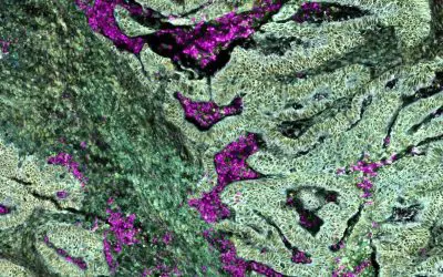 Colorectal cancer with KRAS mutation reprograms neutrophils already in the bone marrow