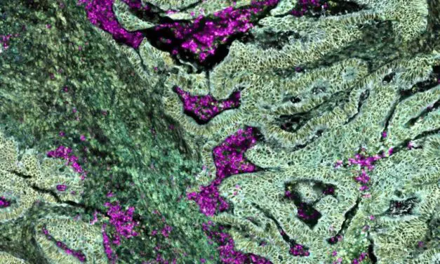 Colorectal cancer with KRAS mutation reprograms neutrophils already in the bone marrow