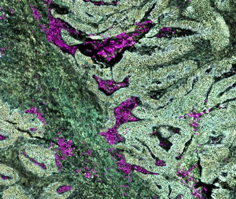 Colorectal cancer with KRAS mutation reprograms neutrophils already in the bone marrow