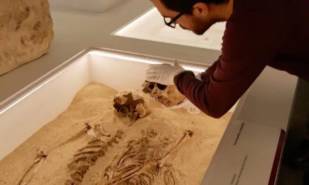 Paleogenomics diagnoses rare growth disorder in 12,000-year-old skeletons