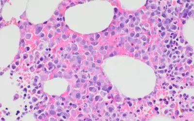 Improved CAR-T cell therapy recognizes myeloma cells by two characteristics