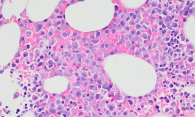 Improved CAR-T cell therapy recognizes myeloma cells by two characteristics