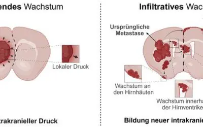Metastases: Study from Regensburg and Erlangen refutes old assumption