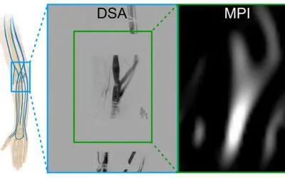 Würzburg: Magnetic particle imaging used on humans for the first time