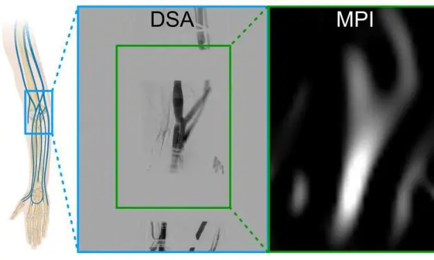 Würzburg: Magnetic particle imaging used on humans for the first time