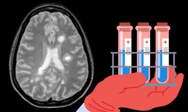 Researchers discover new biomarkers for multiple sclerosis