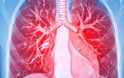Catheter-based ultrasound thrombolysis significantly reduces the risk of severe pulmonary embolism